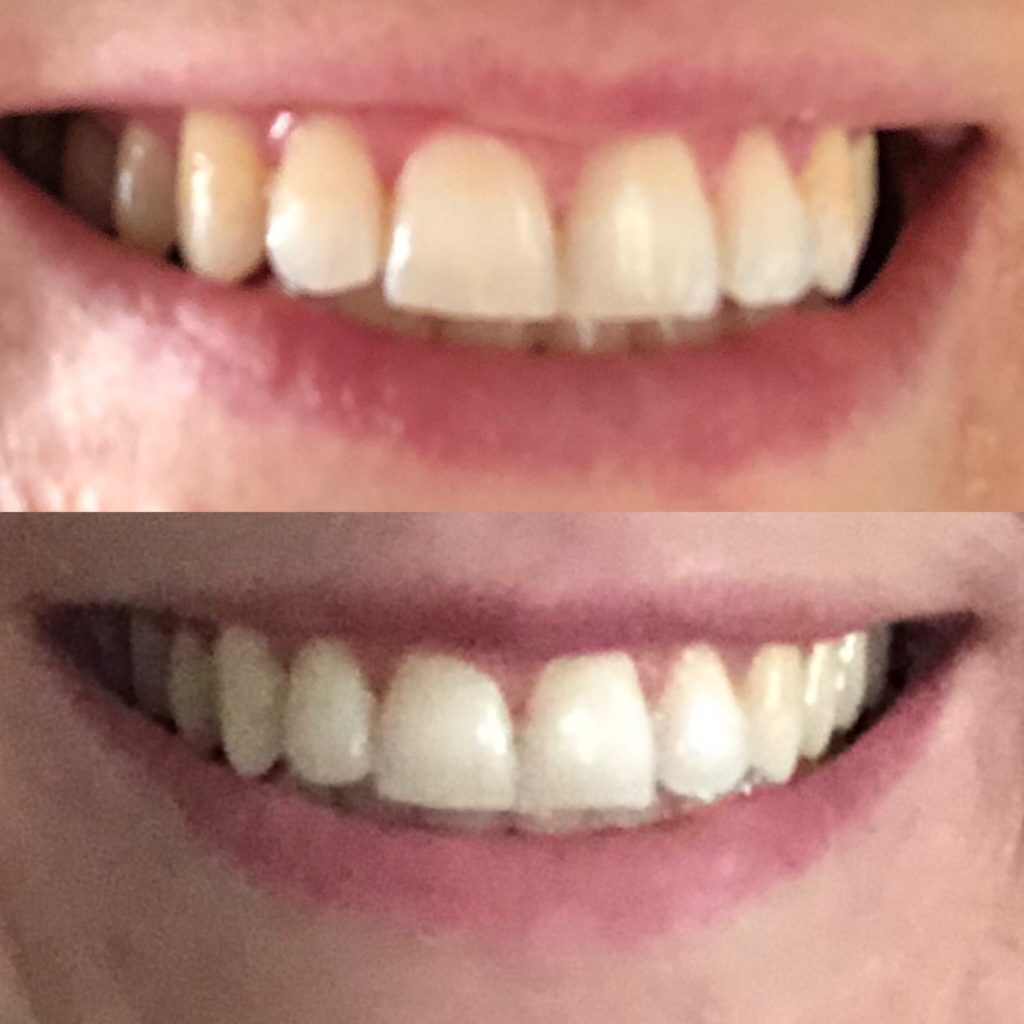 30 Days to a Whiter Smile: AP-24 Put To the Coffee-Addicted Mama Test #ap24whiteningfluoridetoothpaste #teethwhitener #oralcare #drybrushing